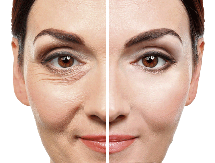 PlasmaPen vorher-nachher